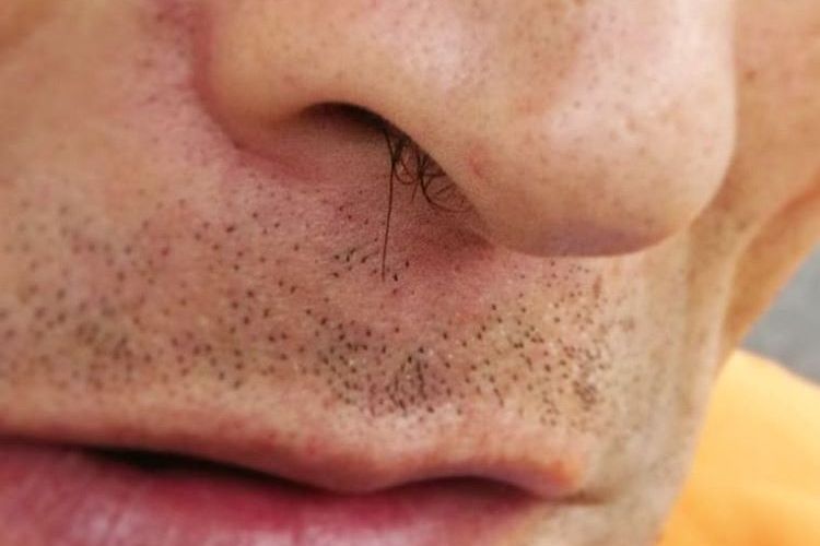 Волосы в носу у мужчин причины